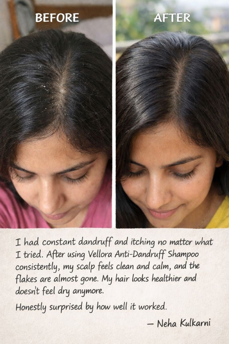 Before and after scalp comparison showing reduced dandruff flakes after using Vellora GlowScalp anti-dandruff shampoo