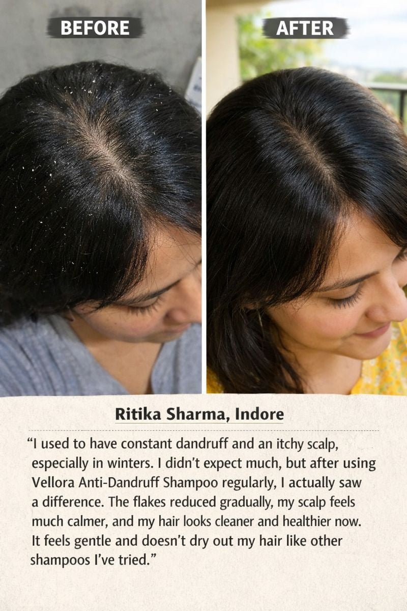 Before and after scalp results showing reduced dandruff and healthier hair after using Vellora GlowScalp Anti-Dandruff Shampoo