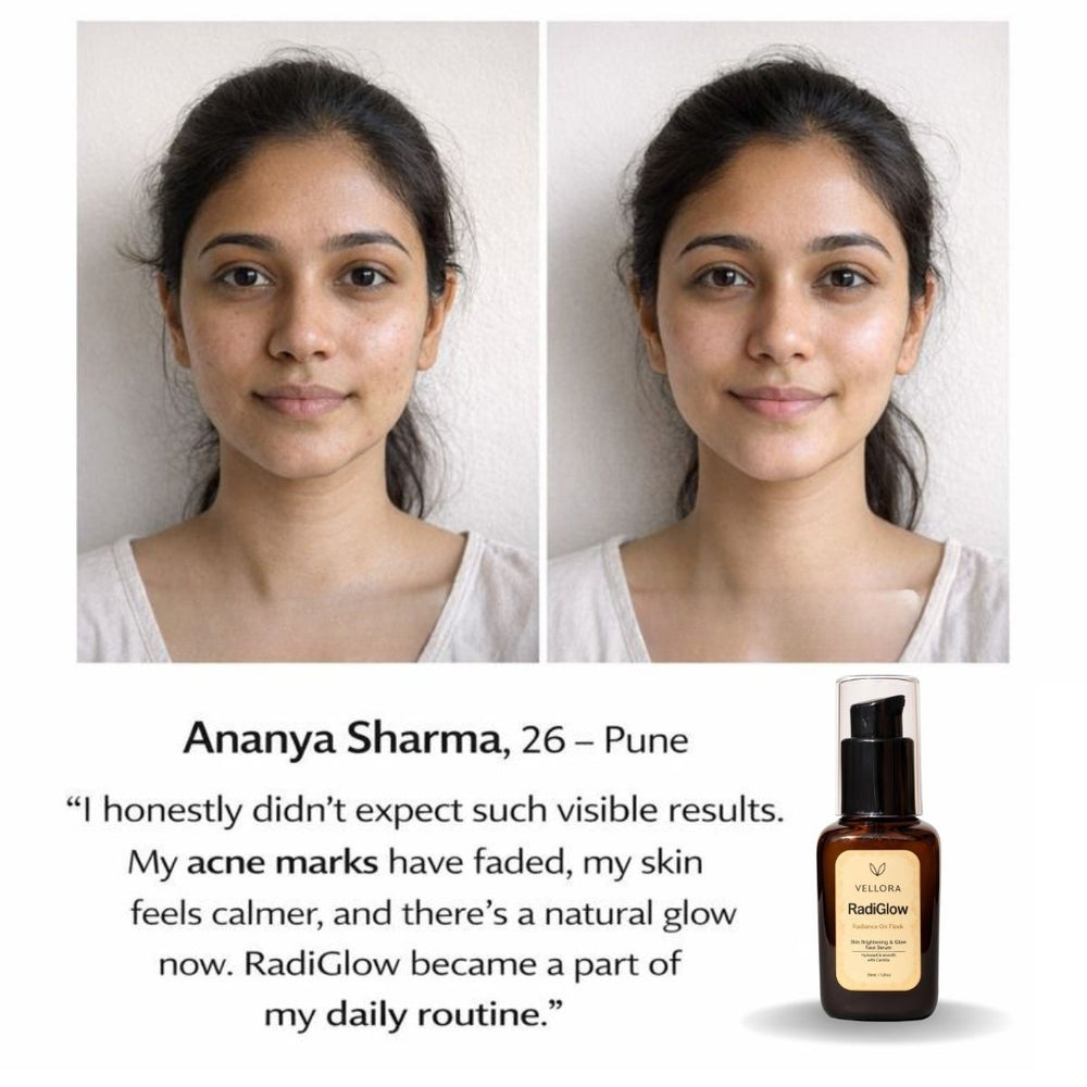 Before and after skincare results showing reduction in acne marks and improved skin glow after 28 days, alongside RadiGlow face serum bottle and customer testimonial.