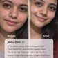 Before and after results of acne-prone skin after using Vellora Aloeem Gel Face Wash showing clearer, calmer skin