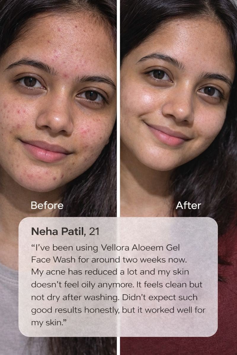 Before and after results of acne-prone skin after using Vellora Aloeem Gel Face Wash showing clearer, calmer skin