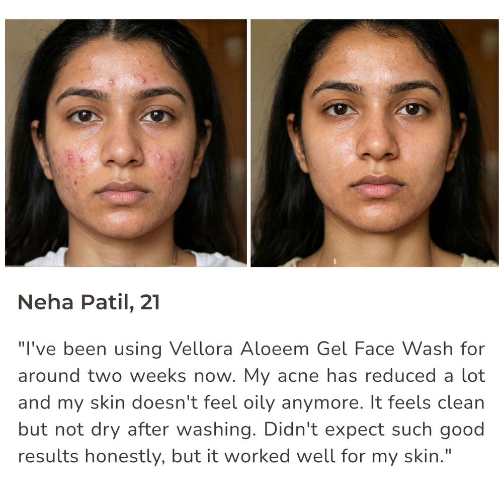Before and after results of acne-prone skin after using Vellora Aloeem Gel Face Wash showing clearer, calmer skin