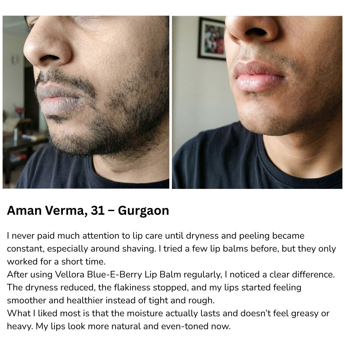 Before and after comparison showing reduced lip dryness and smoother-looking lips after regular use of Vellora Blue E-Berry Lip Balm.