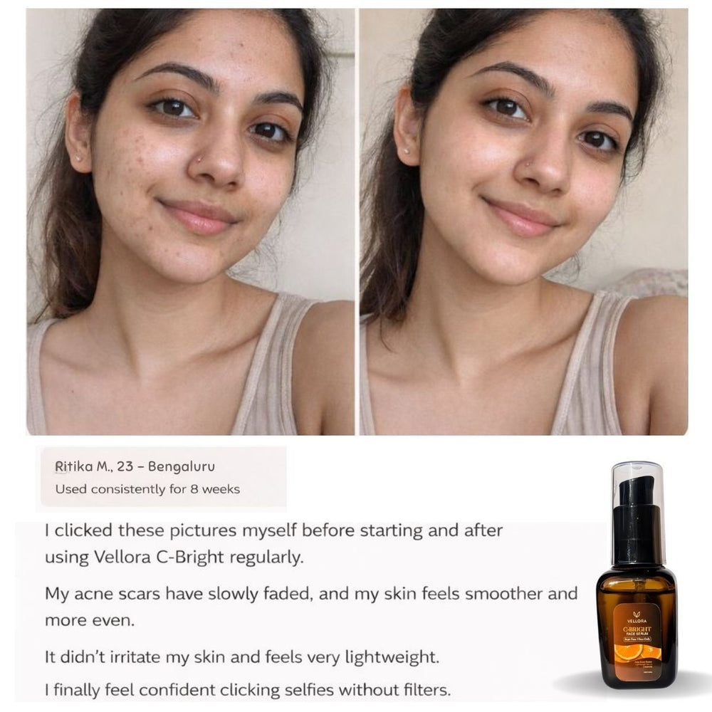 Before and after results of acne scar reduction and brighter, smoother skin after 8 weeks of using Vellora C-Bright face serum, shown with product bottle.